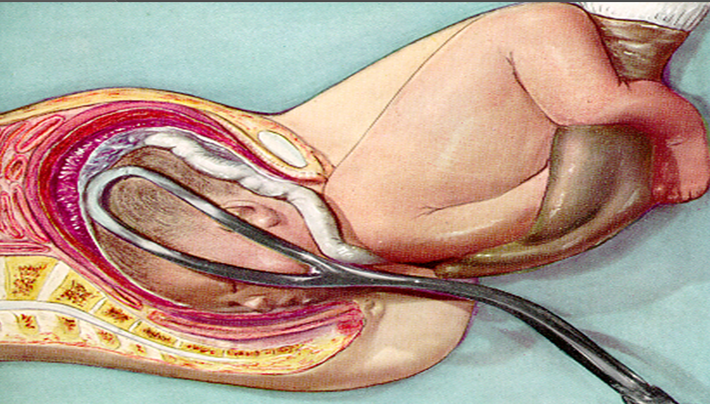 FORCEPS DELIVERY – Nursing Powerpoint Presentations